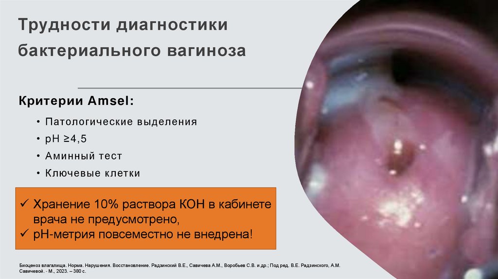 Трудности диагностики бактериального вагиноза