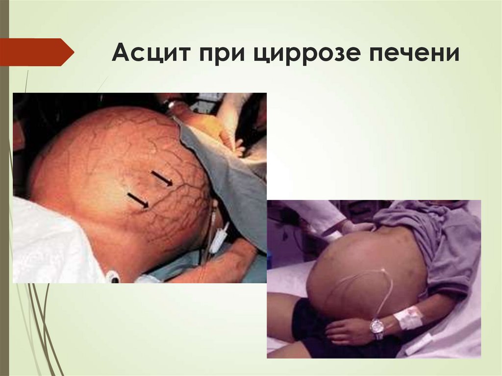 Асцит при циррозе печени
