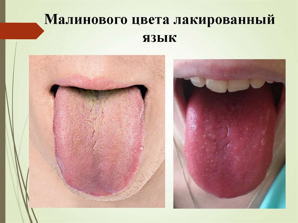 Малинового цвета лакированный язык