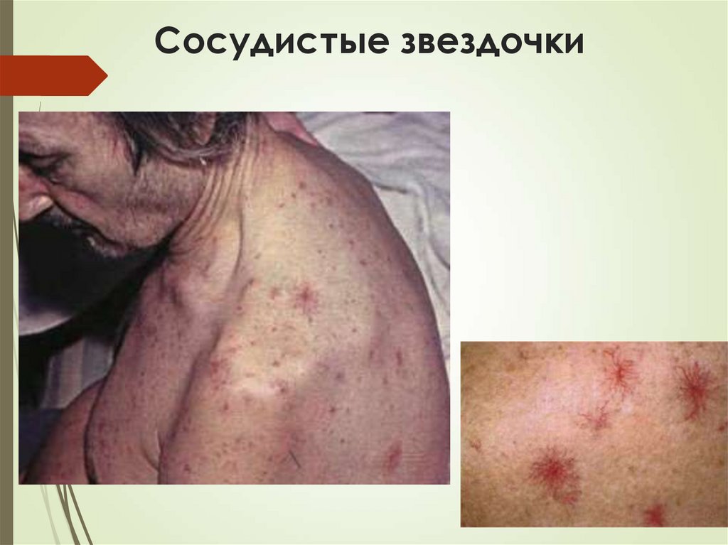 Сосудистые звездочки