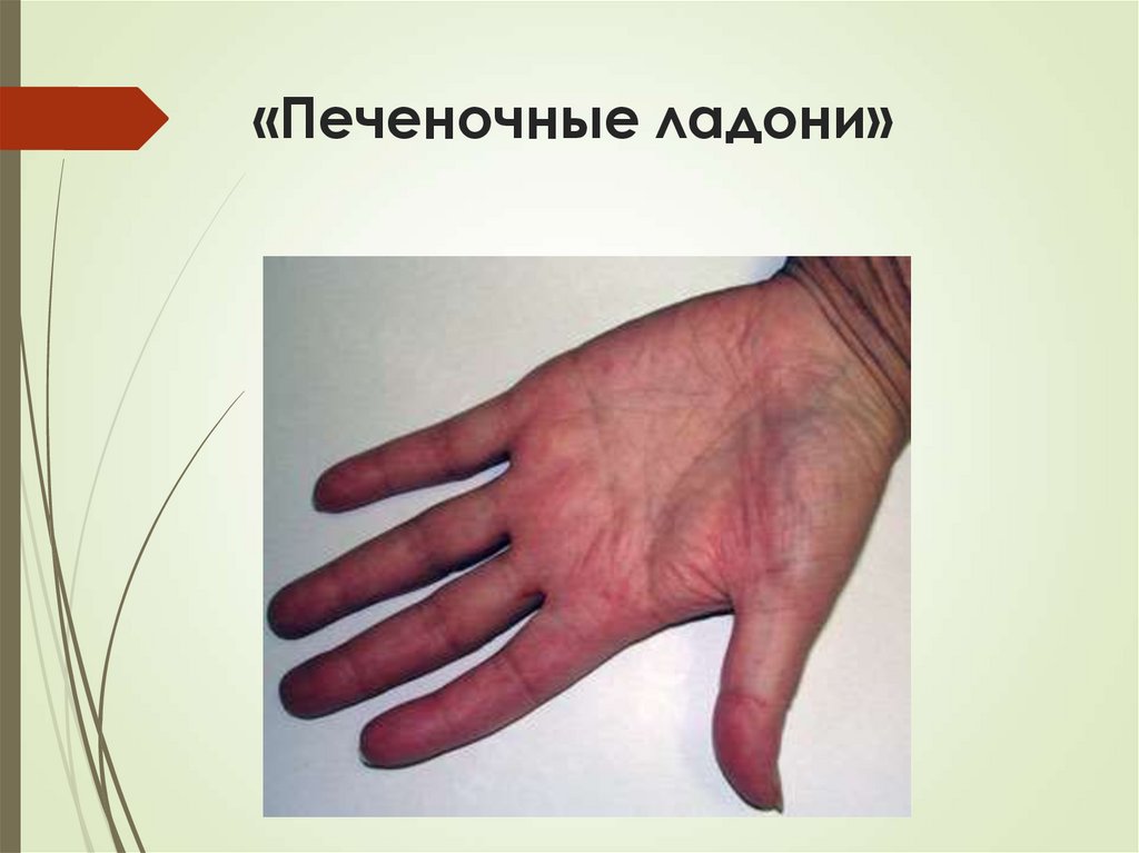 «Печеночные ладони»