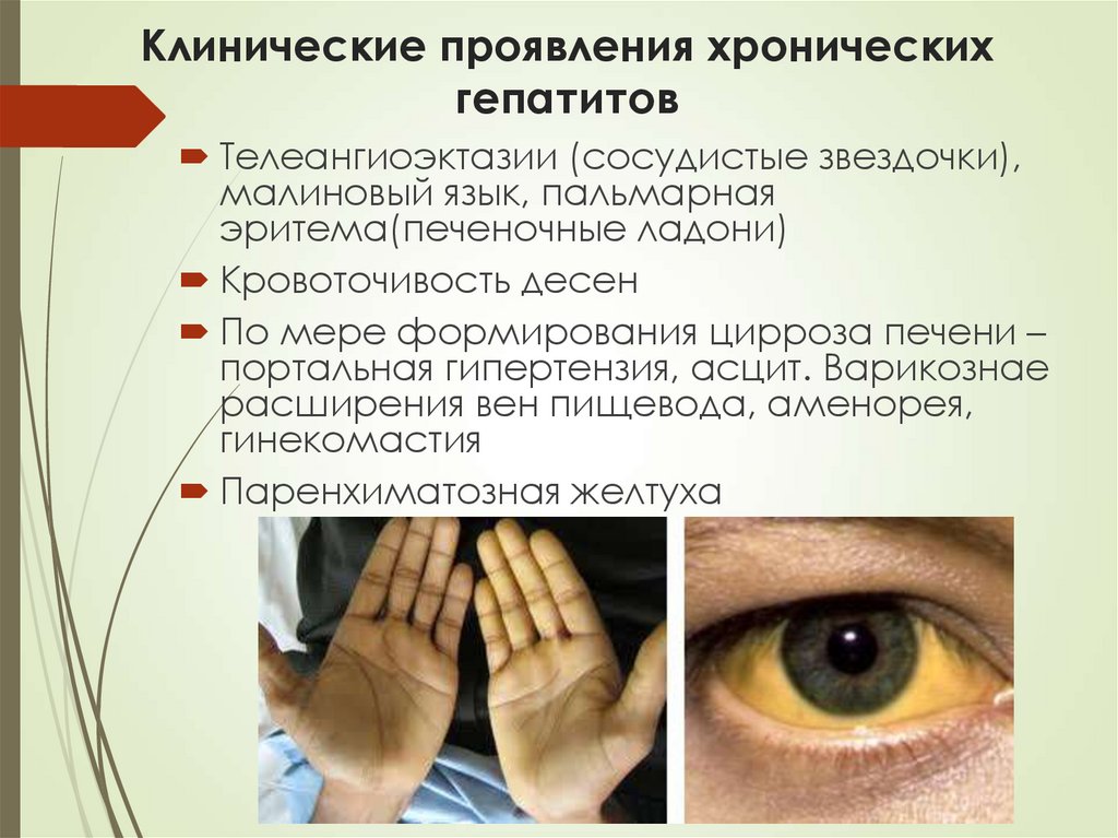 Клинические проявления хронических гепатитов