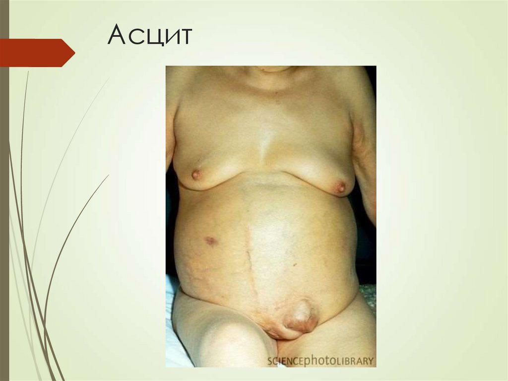 Асцит
