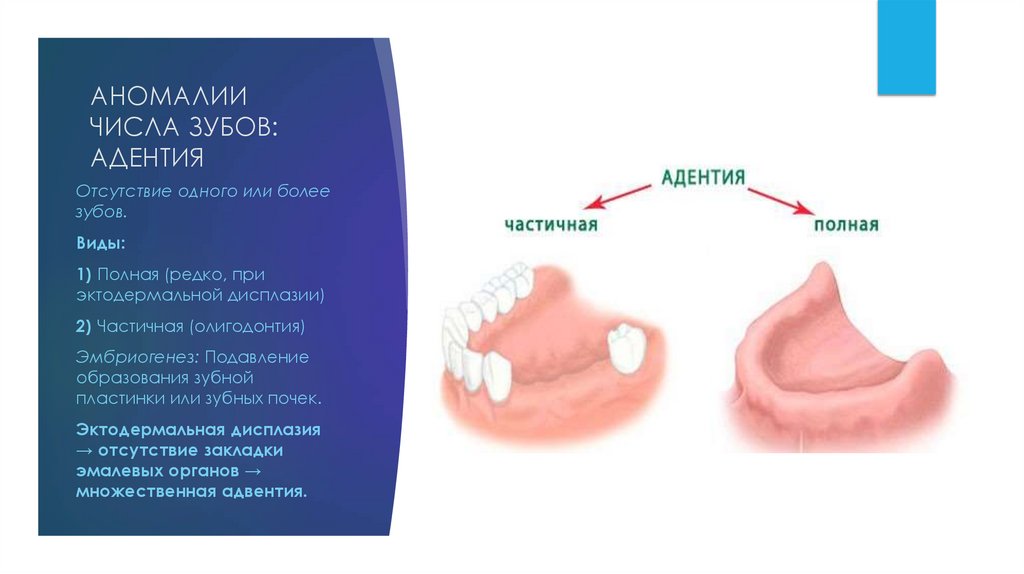 АНОМАЛИИ ЧИСЛА ЗУБОВ: АДЕНТИЯ