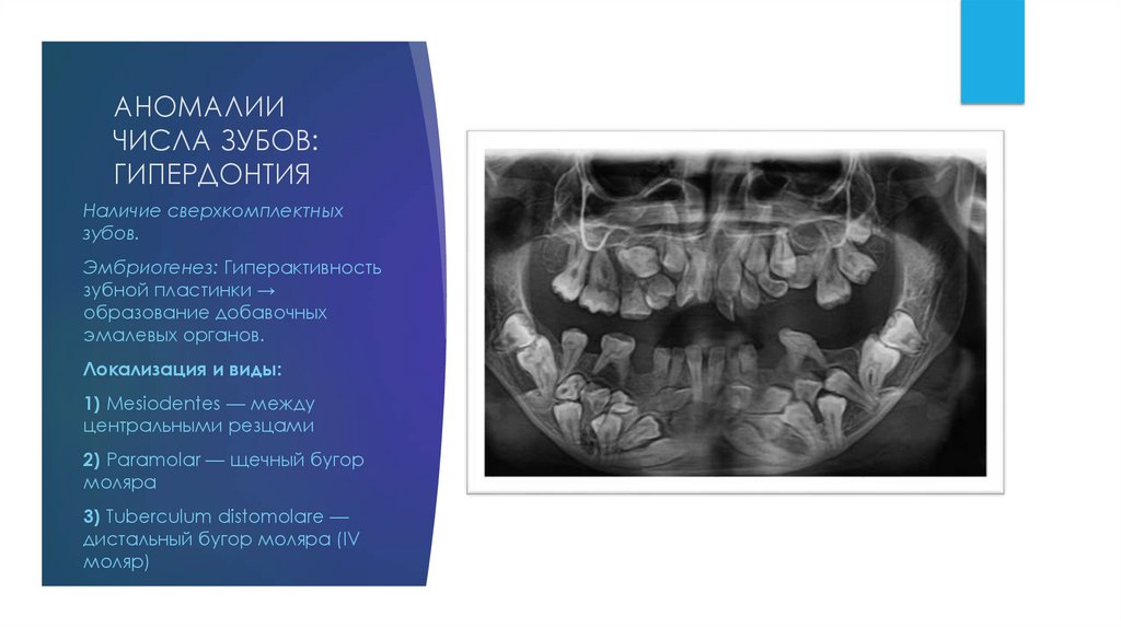 АНОМАЛИИ ЧИСЛА ЗУБОВ: ГИПЕРДОНТИЯ