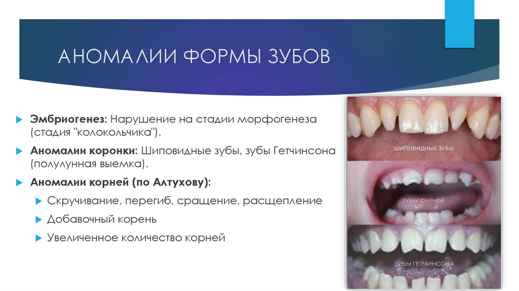 АНОМАЛИИ ФОРМЫ ЗУБОВ