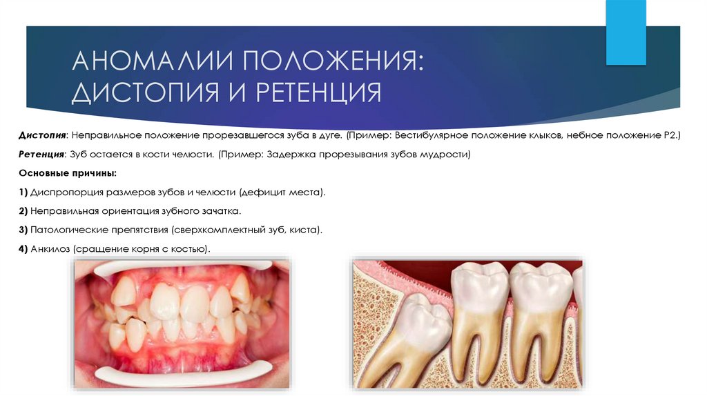 АНОМАЛИИ ПОЛОЖЕНИЯ: ДИСТОПИЯ И РЕТЕНЦИЯ