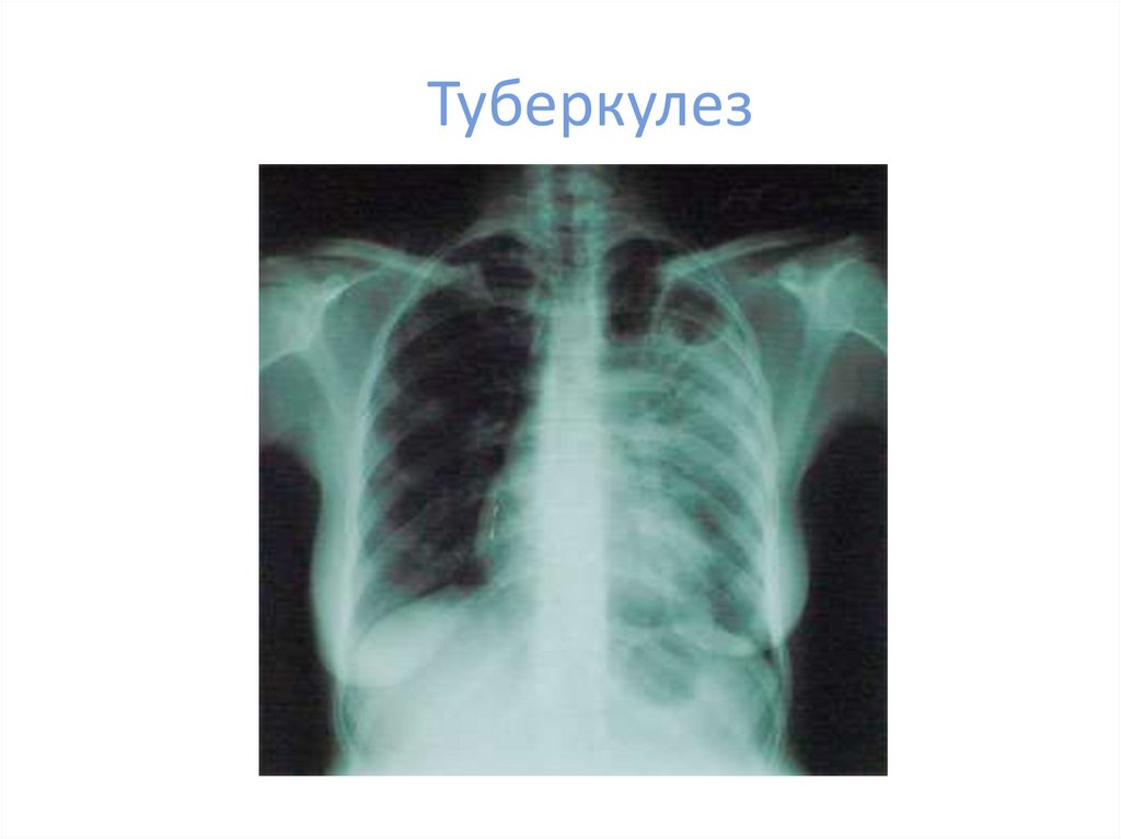 Туберкулез