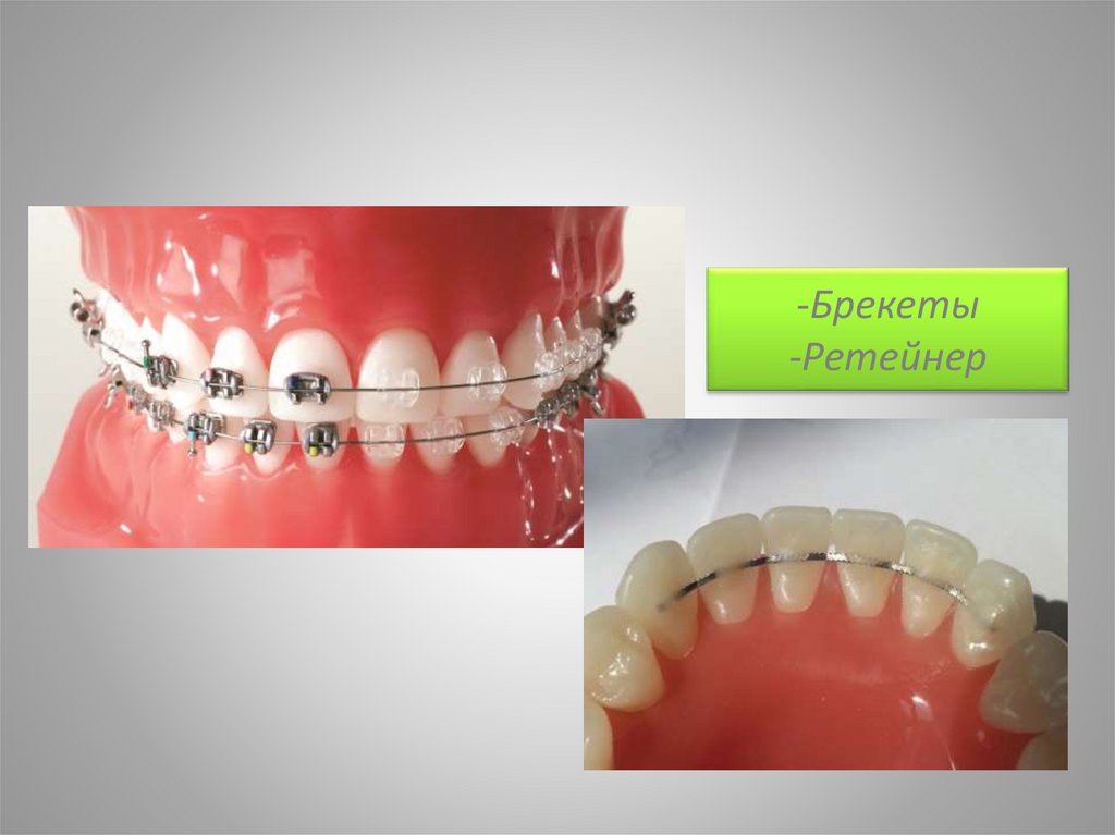 -Брекеты -Ретейнер