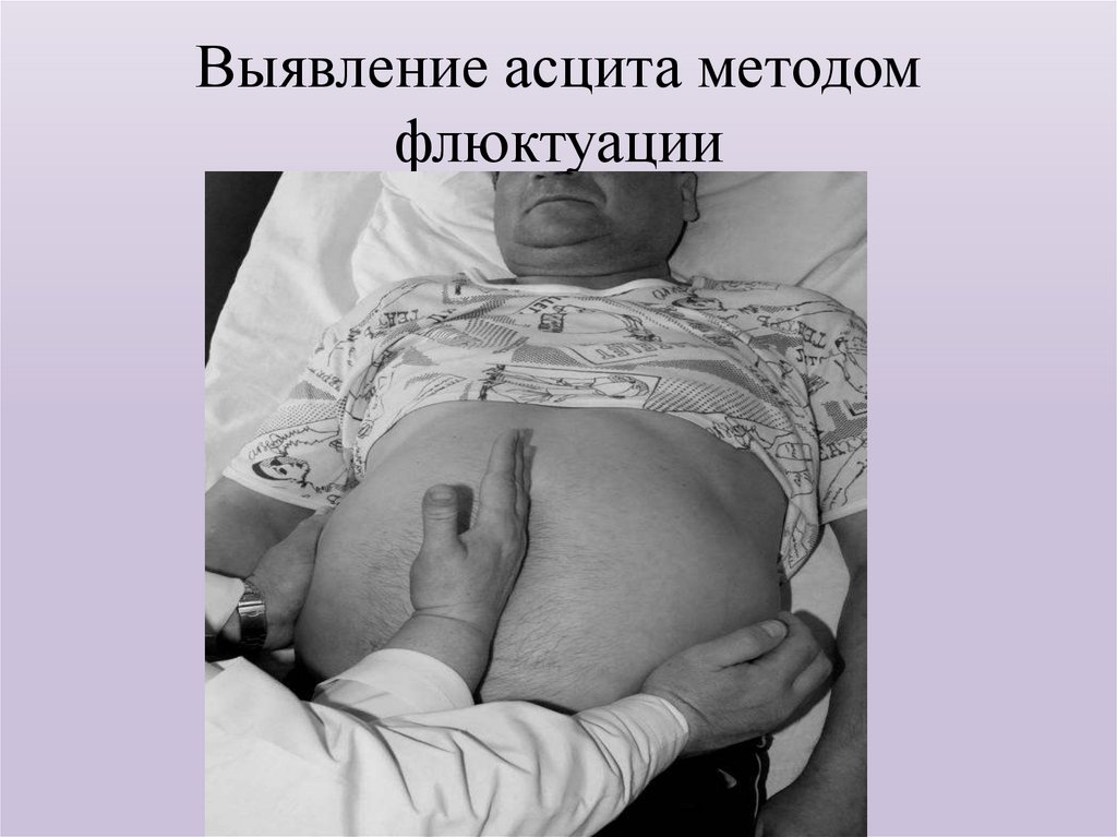 Выявление асцита методом флюктуации