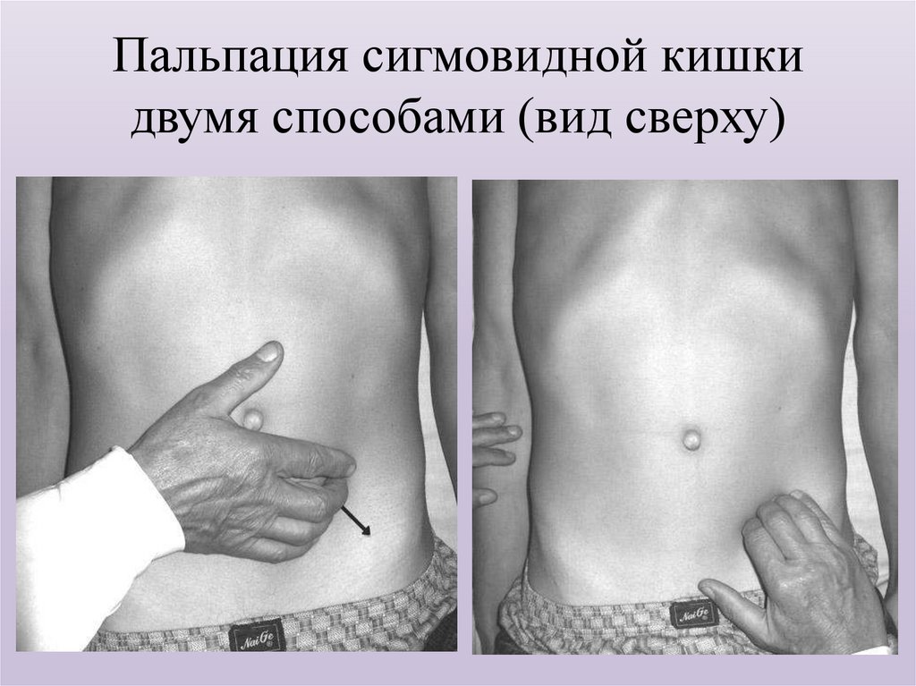 Пальпация сигмовидной кишки двумя способами (вид сверху)