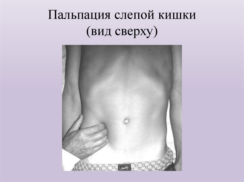 Пальпация слепой кишки (вид сверху)