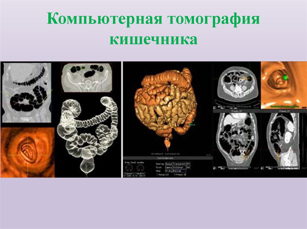 Компьютерная томография кишечника