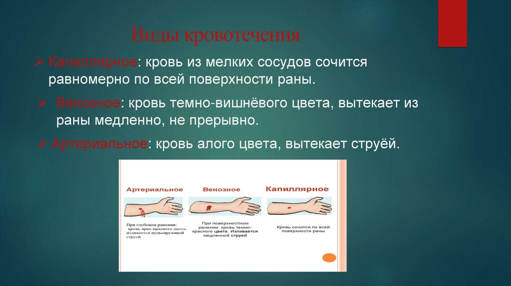 Виды кровотечения