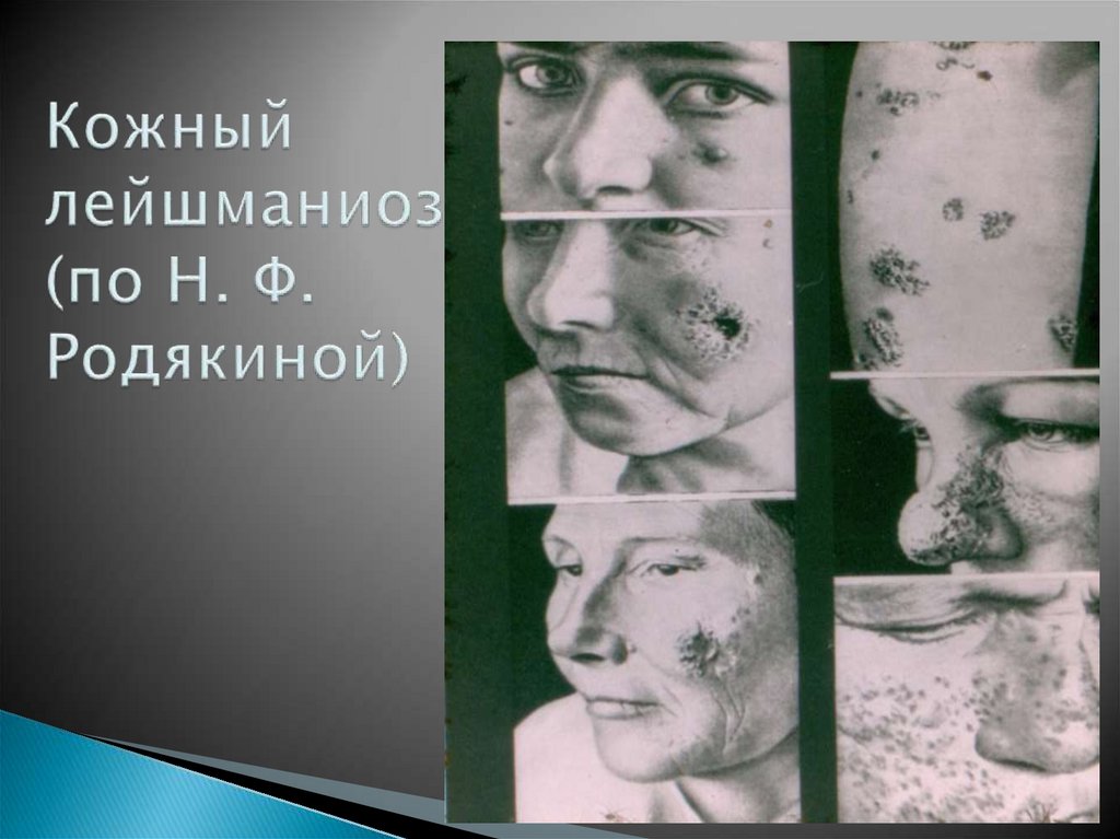 Кожный лейшманиоз (по Н. Ф. Родякиной)