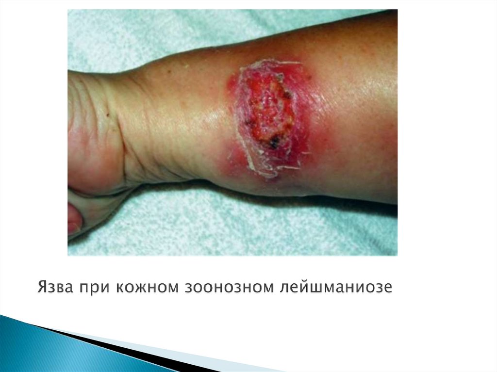 Язва при кожном зоонозном лейшманиозе