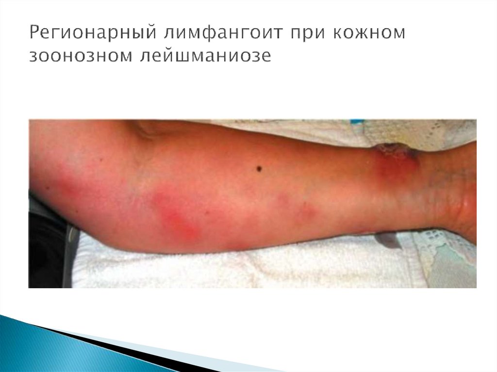 Регионарный лимфангоит при кожном зоонозном лейшманиозе
