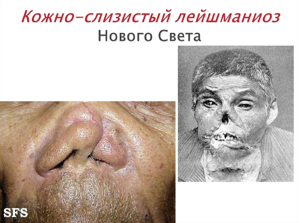 Кожно-слизистый лейшманиоз Нового Света