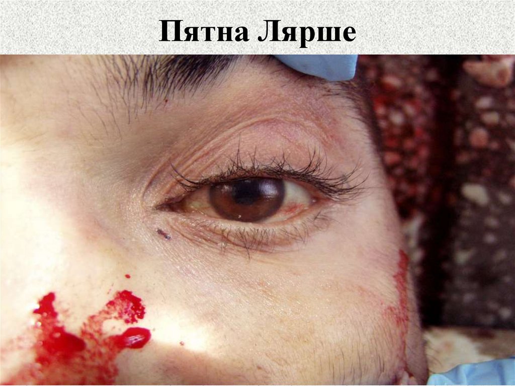 Пятна Лярше