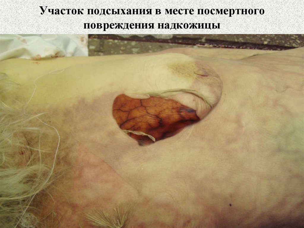 Участок подсыхания в месте посмертного повреждения надкожицы