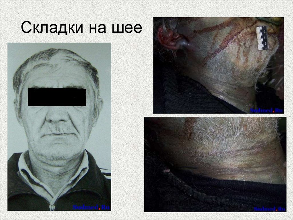 Складки на шее