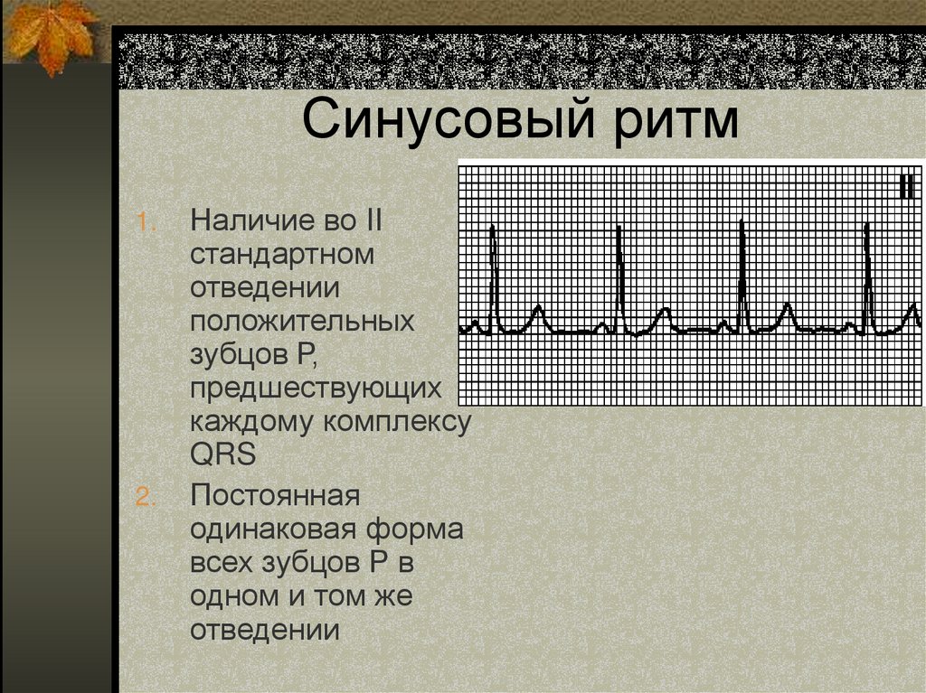 Синусовый ритм