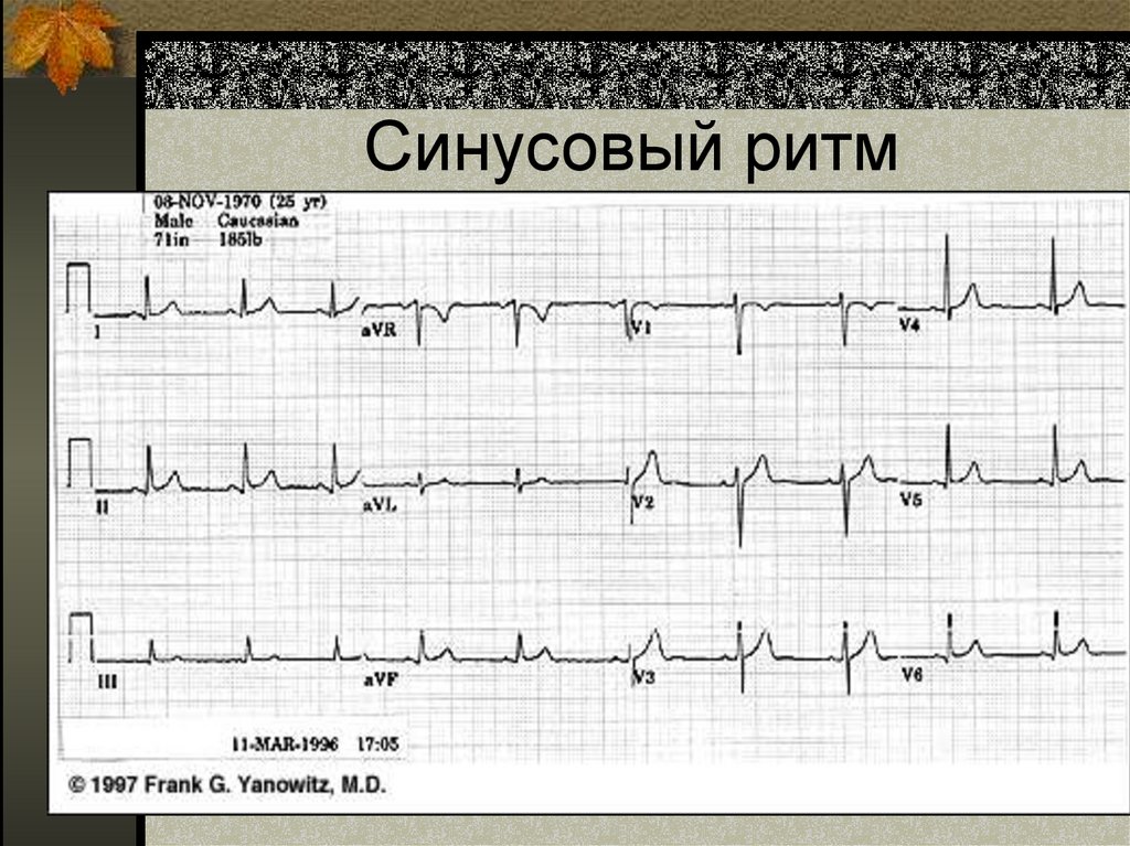 Синусовый ритм