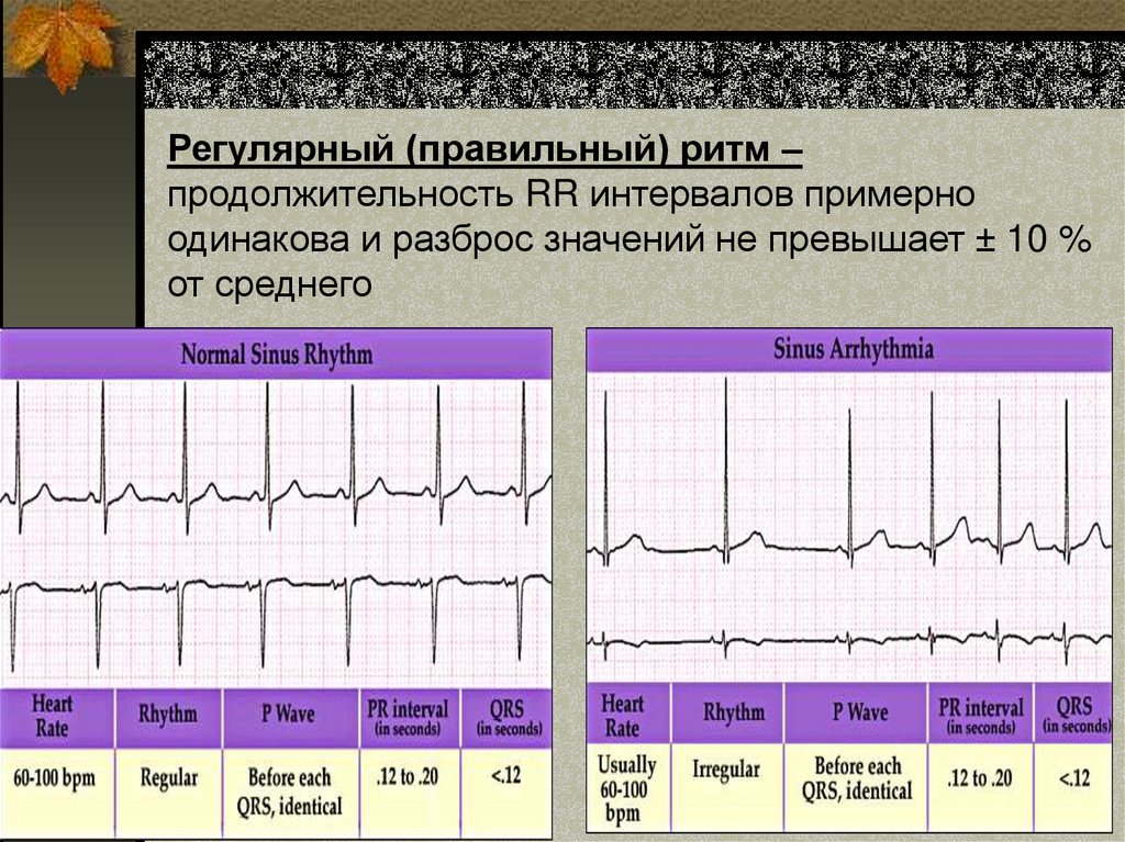 Регулярный (правильный) ритм – продолжительность RR интервалов примерно одинакова и разброс значений не превышает ± 10 % от
