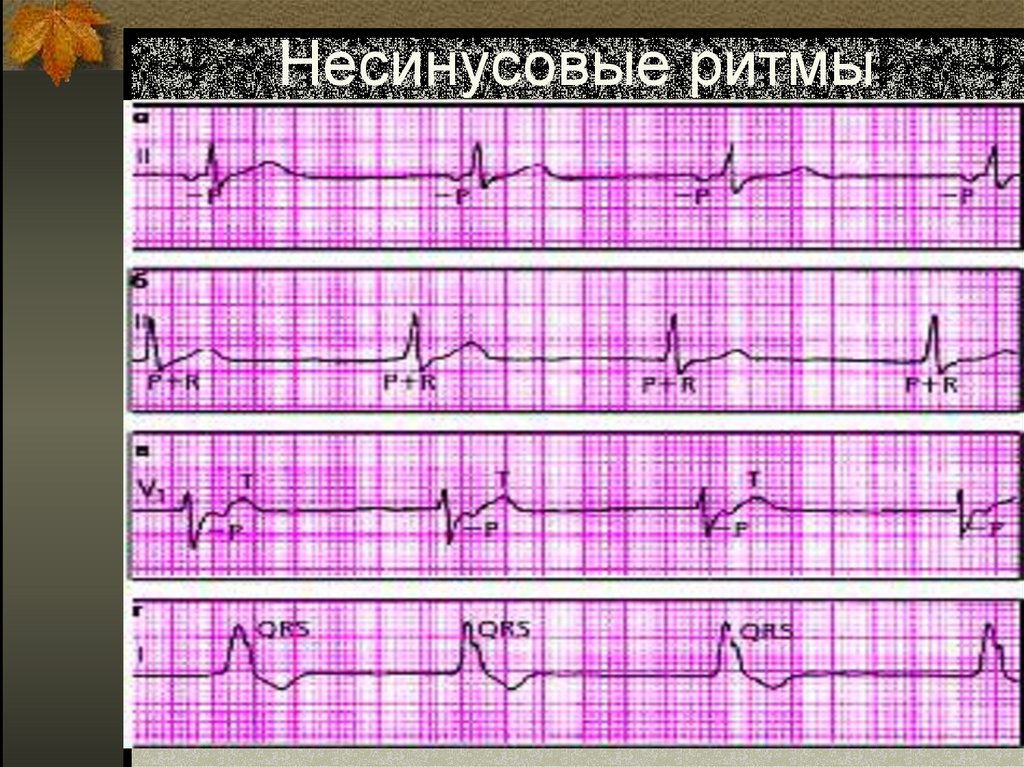 Несинусовые ритмы