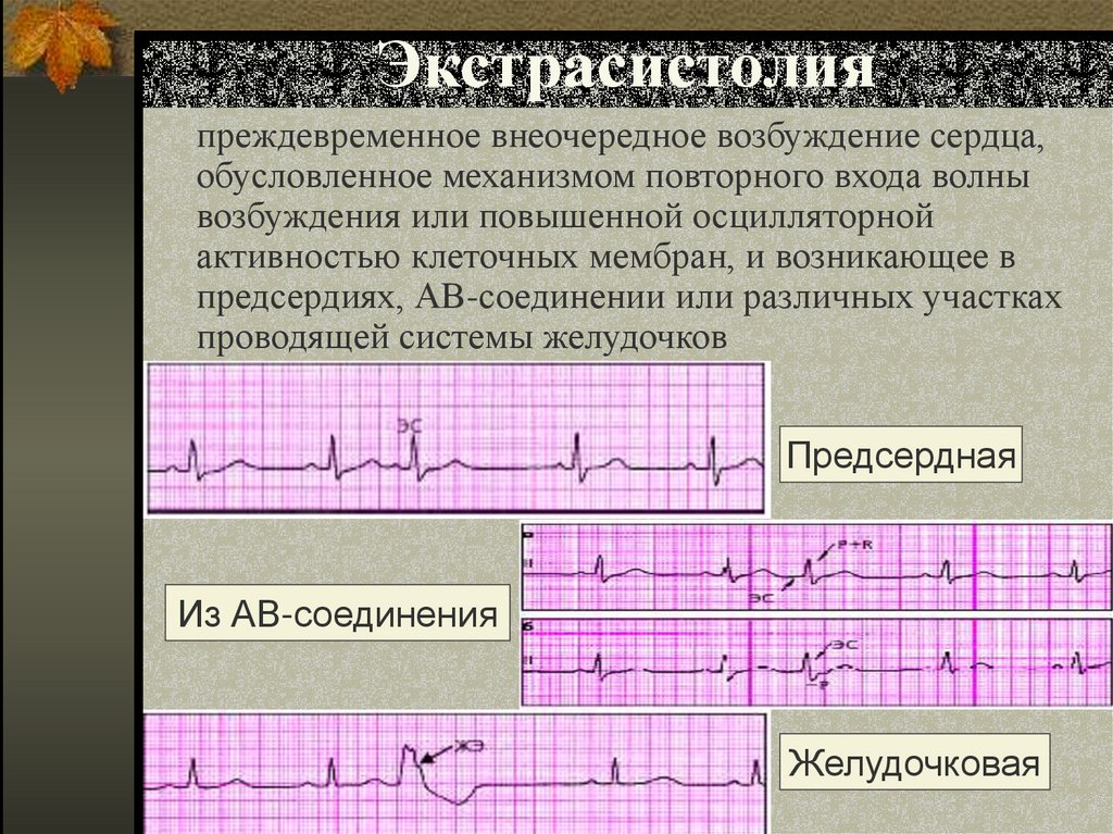 Экстрасистолия