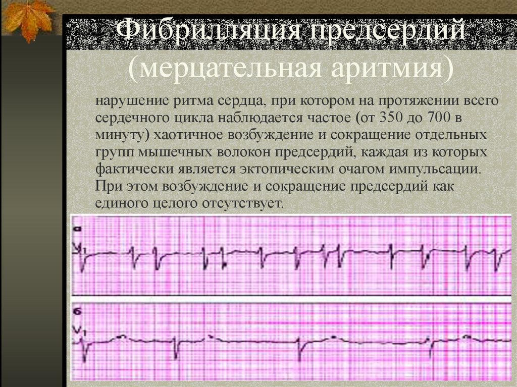 Фибрилляция предсердий (мерцательная аритмия)