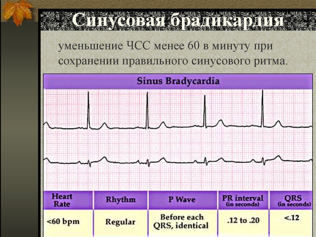 Синусовая брадикардия
