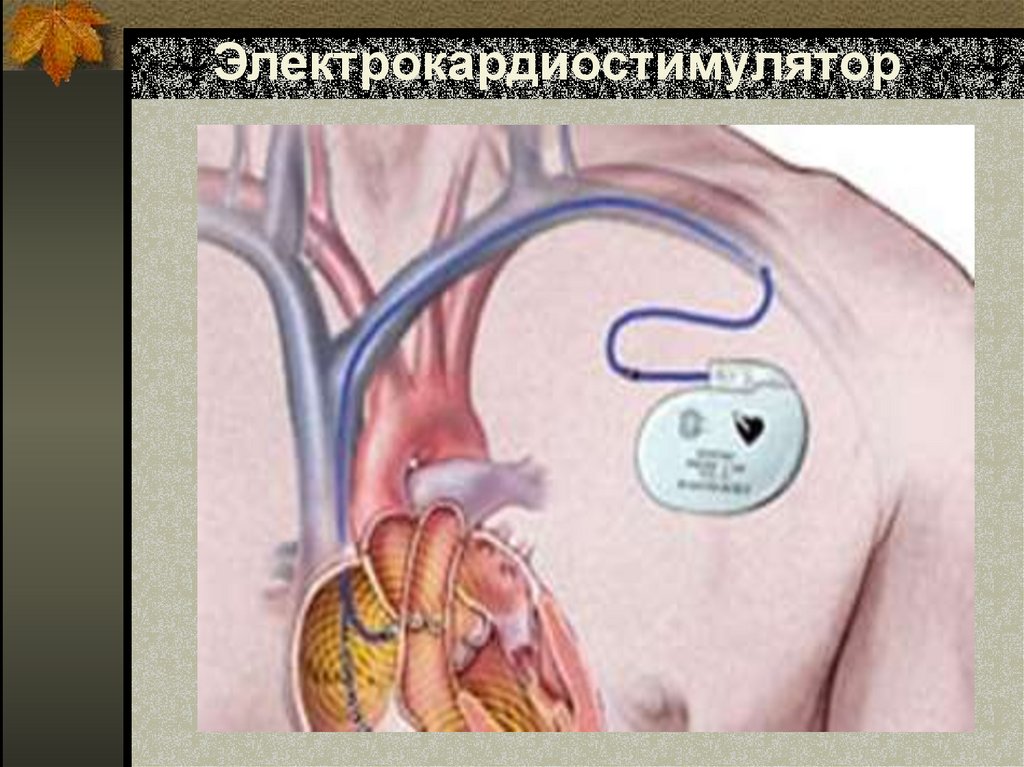 Электрокардиостимулятор