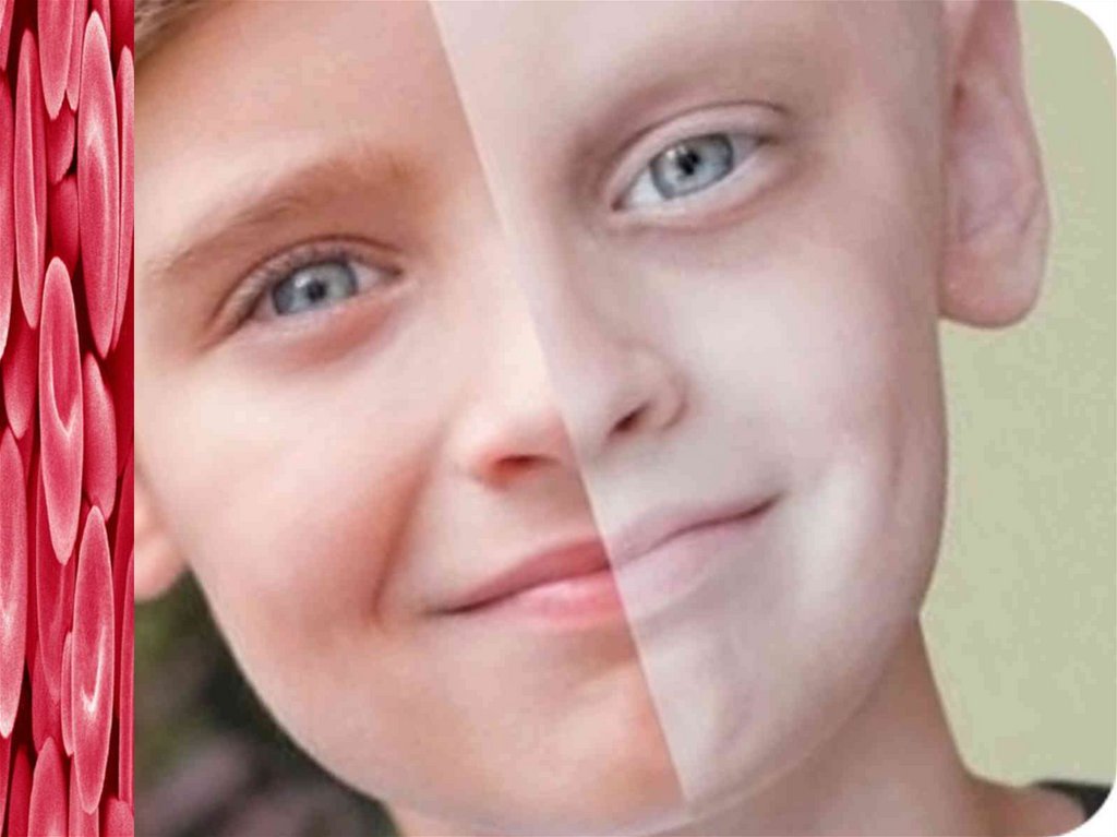 Общие симптомы анемии: