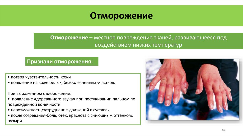 Отморожение