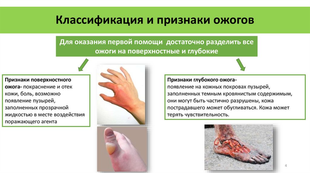 Классификация и признаки ожогов