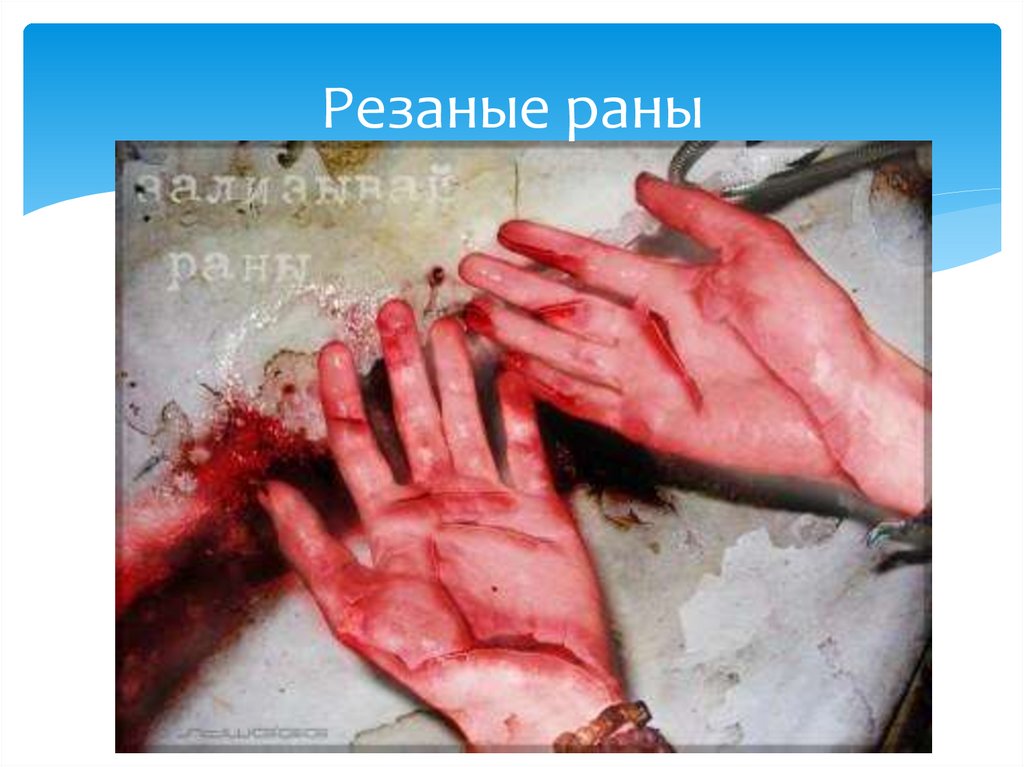 Резаные раны
