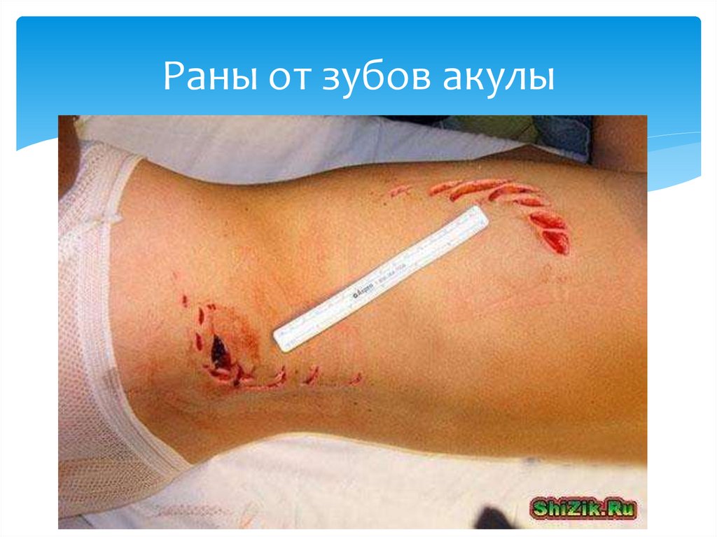 Раны от зубов акулы