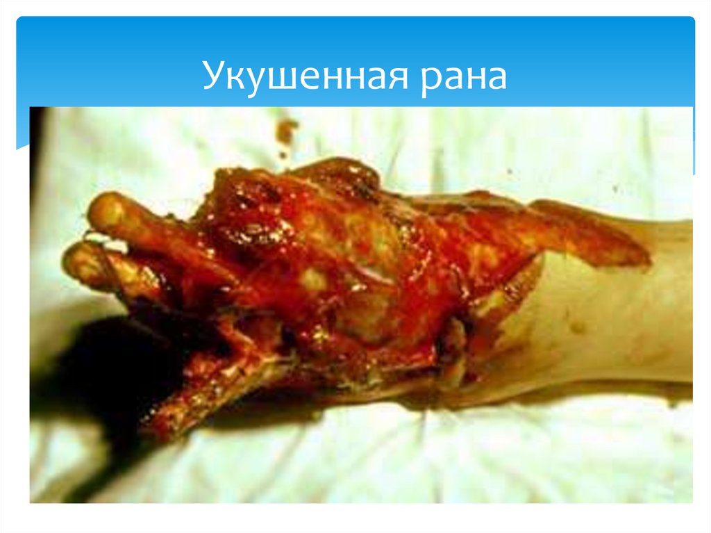 Укушенная рана