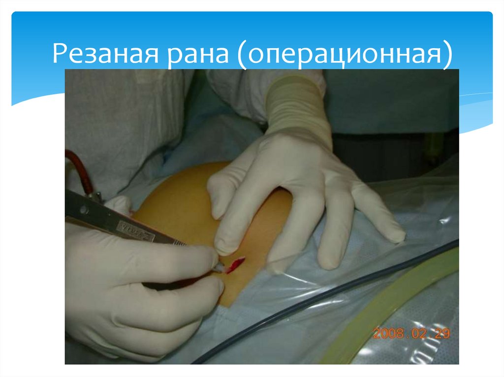 Резаная рана (операционная)