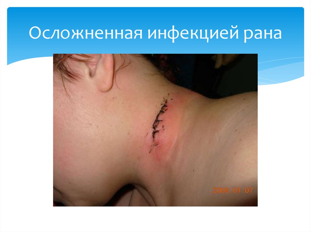 Осложненная инфекцией рана