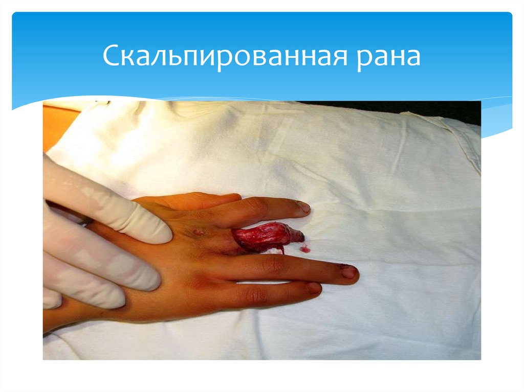 Скальпированная рана