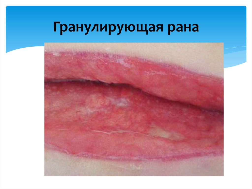 Гранулирующая рана