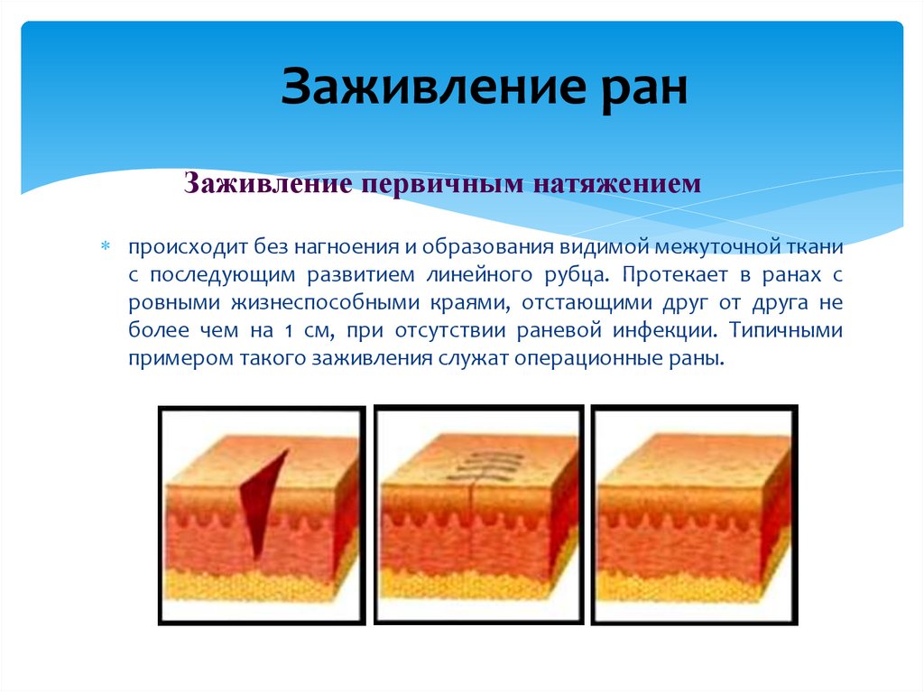 Заживление ран