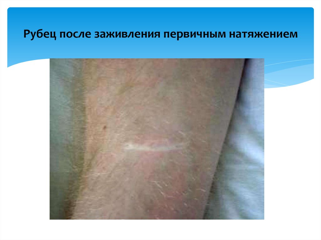 Рубец после заживления первичным натяжением