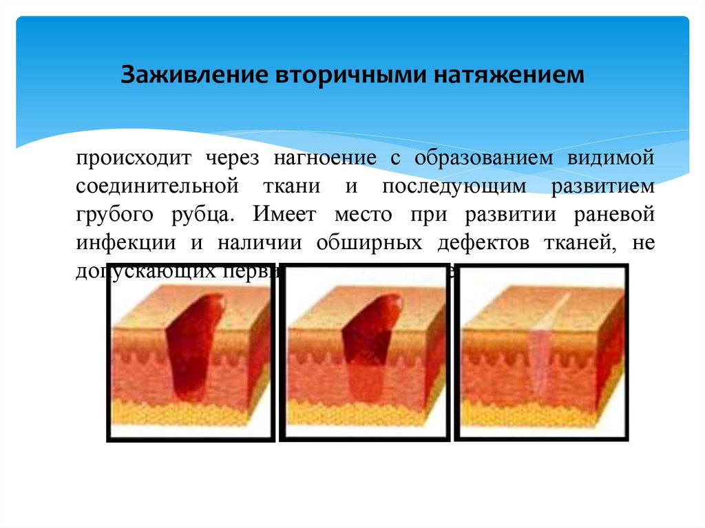 Заживление вторичными натяжением