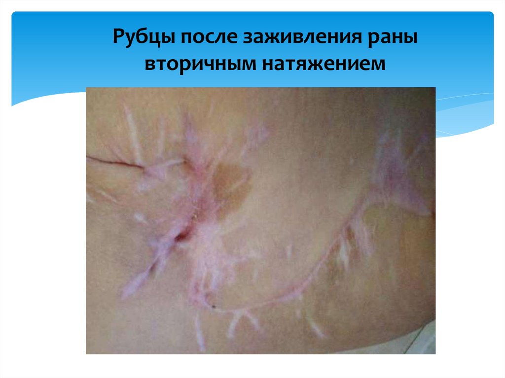 Рубцы после заживления раны вторичным натяжением