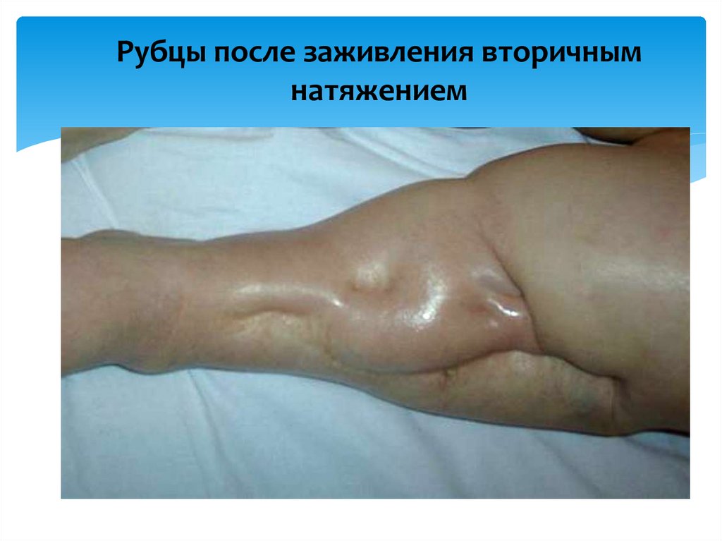 Рубцы после заживления вторичным натяжением