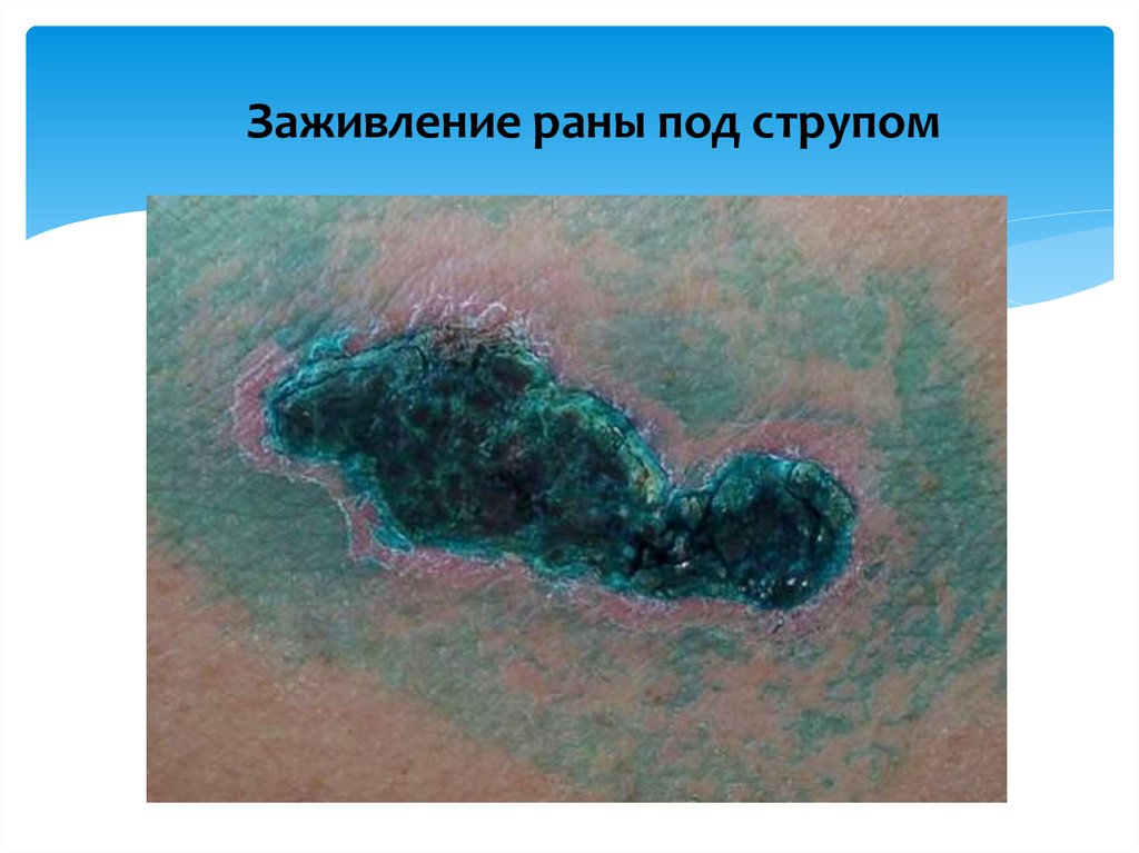 Заживление раны под струпом