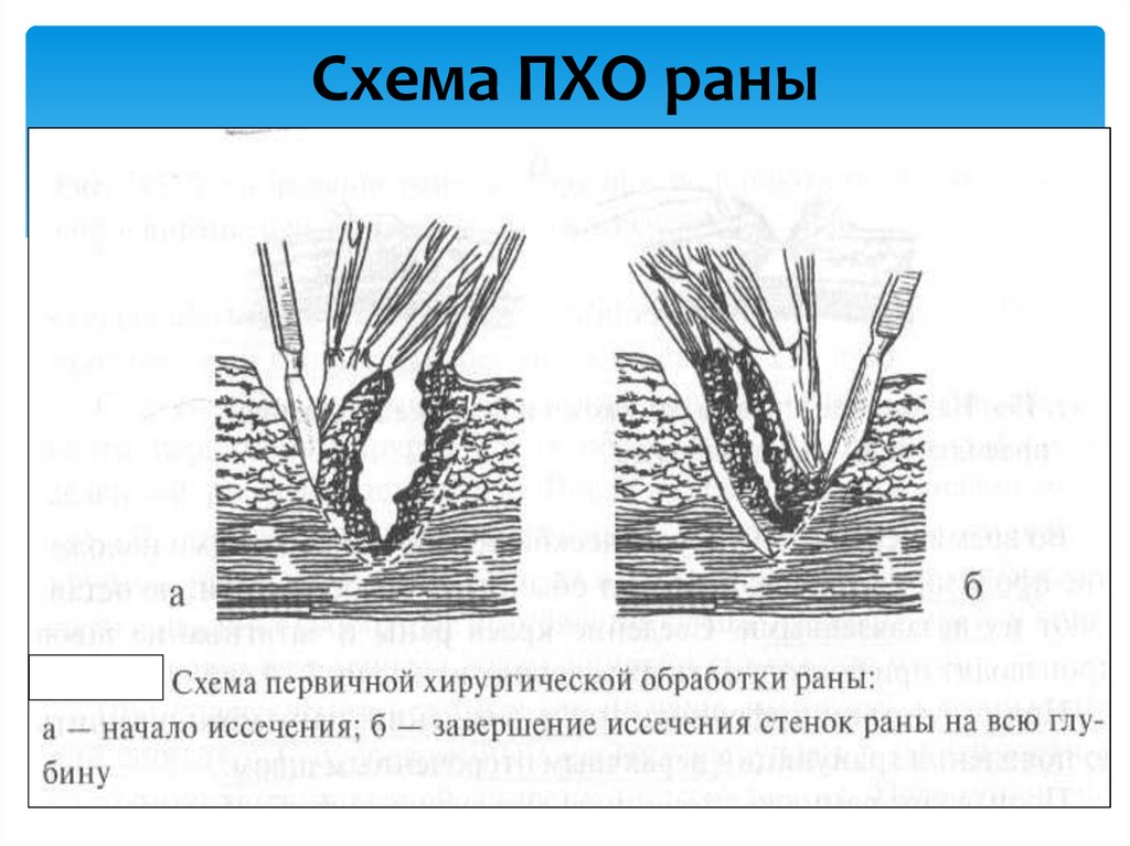 Схема ПХО раны